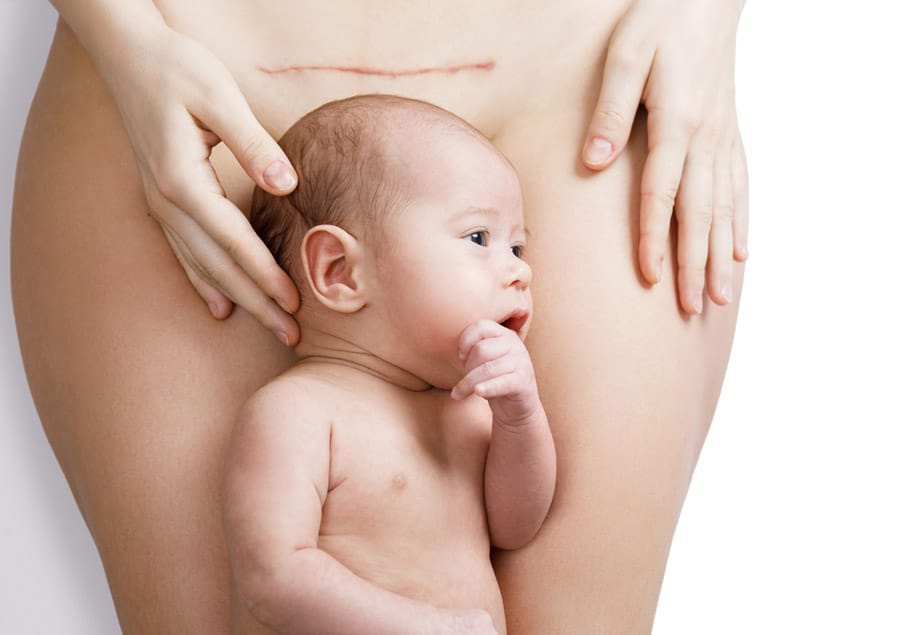 Blog: Ins en outs van een keizersnee | Proud MaMa